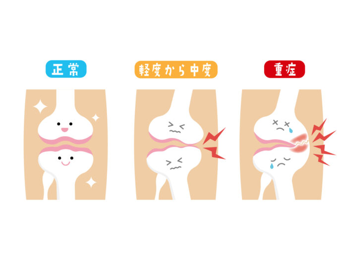 今治　変形性関節症　玄鍼灸院