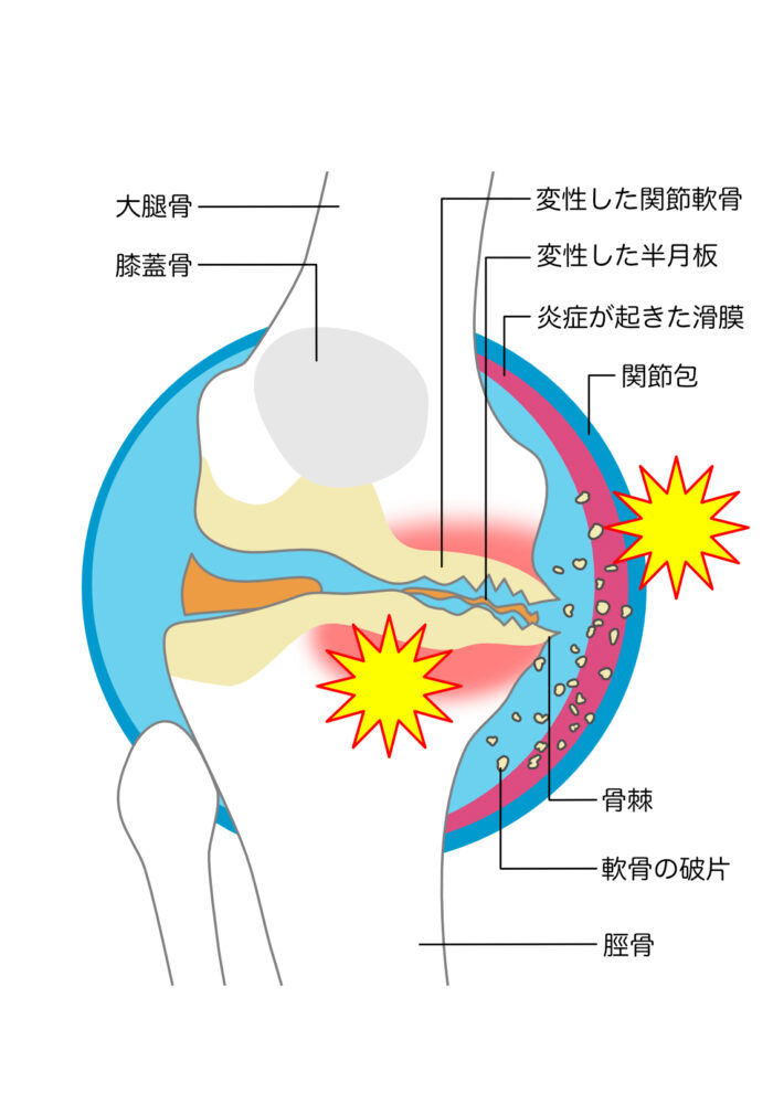 今治　変形性関節症　玄鍼灸院