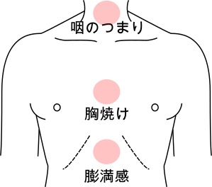 今治　玄鍼灸院　機能性ディスペプシア