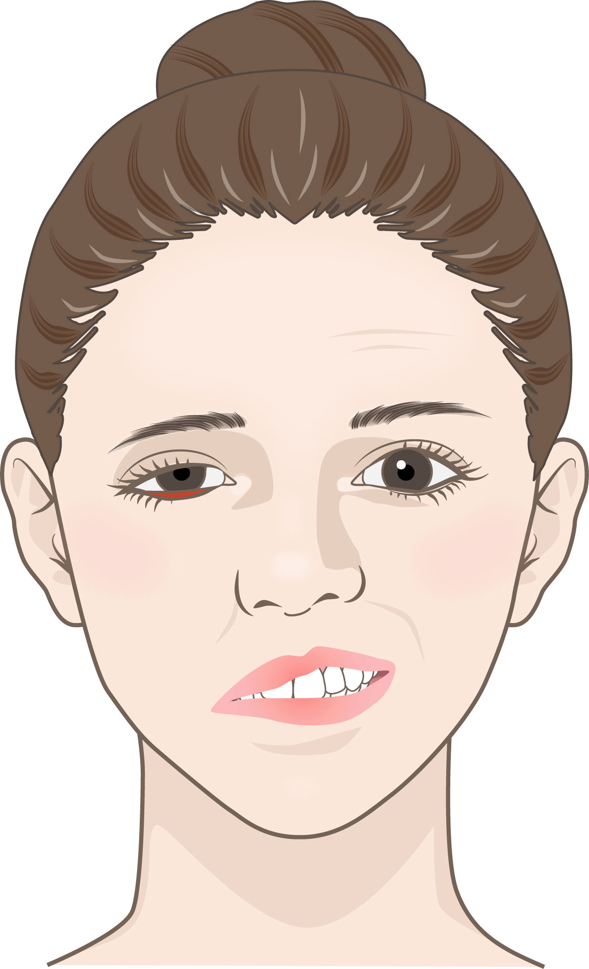 今治　玄鍼灸院　顔面神経麻痺